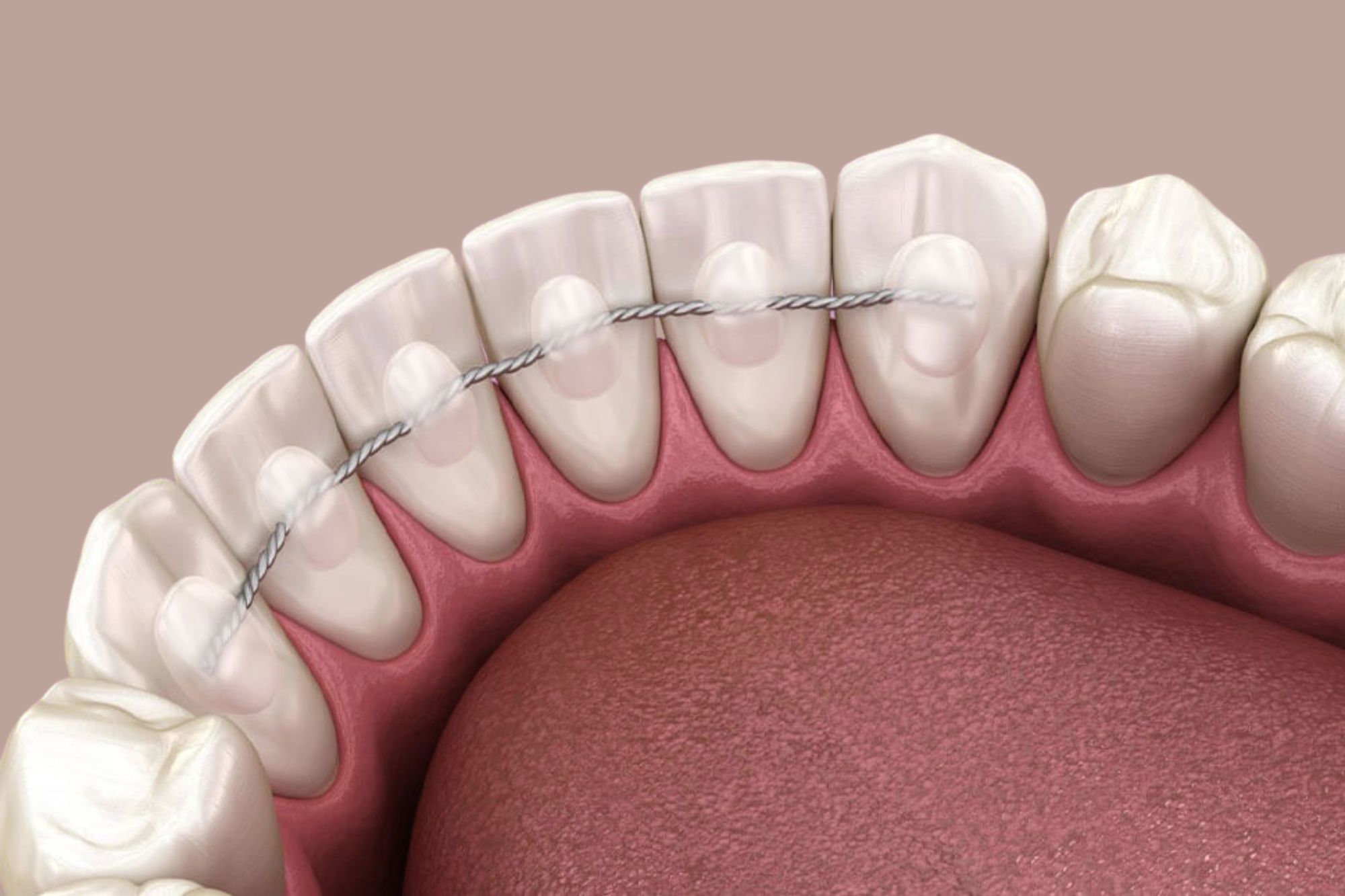 teeth retainer Damansara uptown