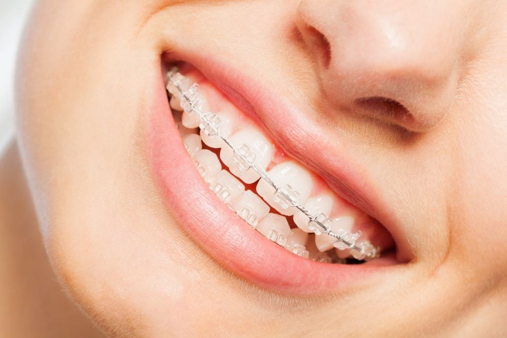 dental braces service Damansara uptown