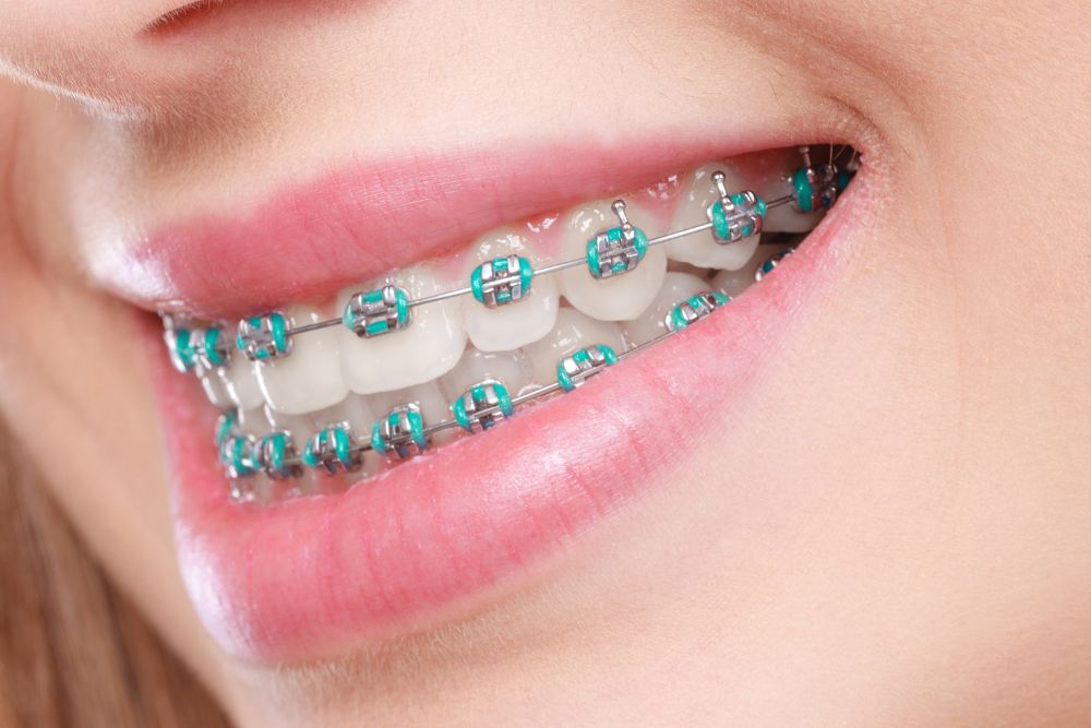dental braces Damansara uptown