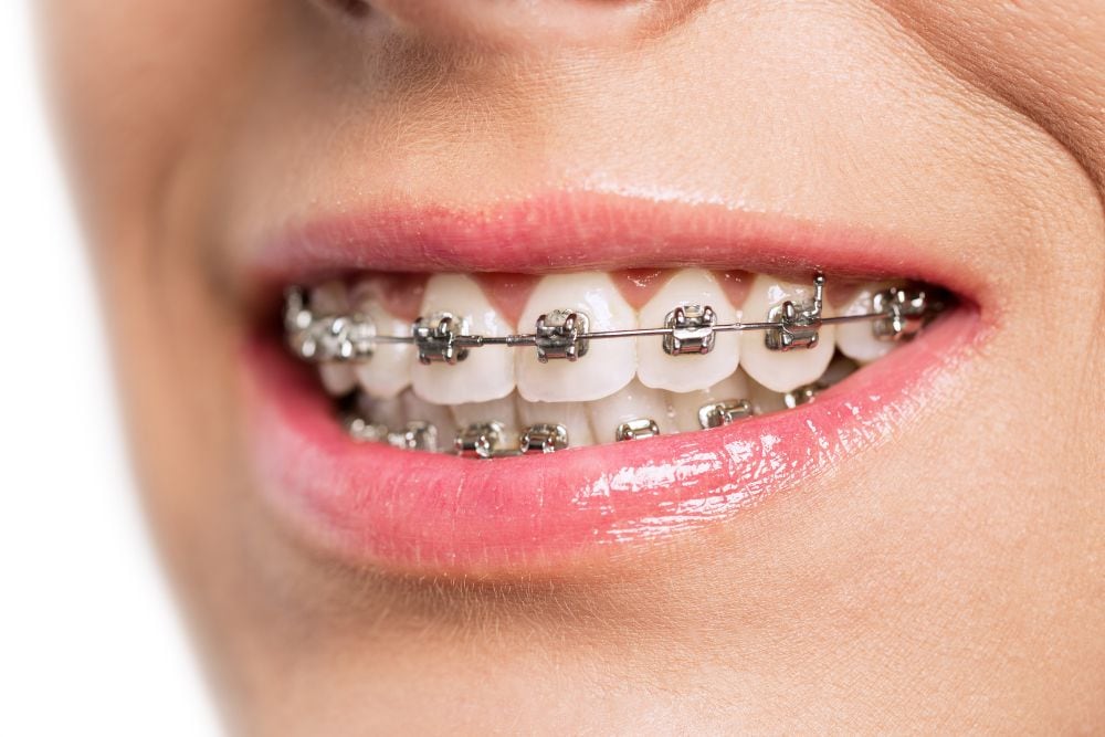 dental braces Damansara uptown