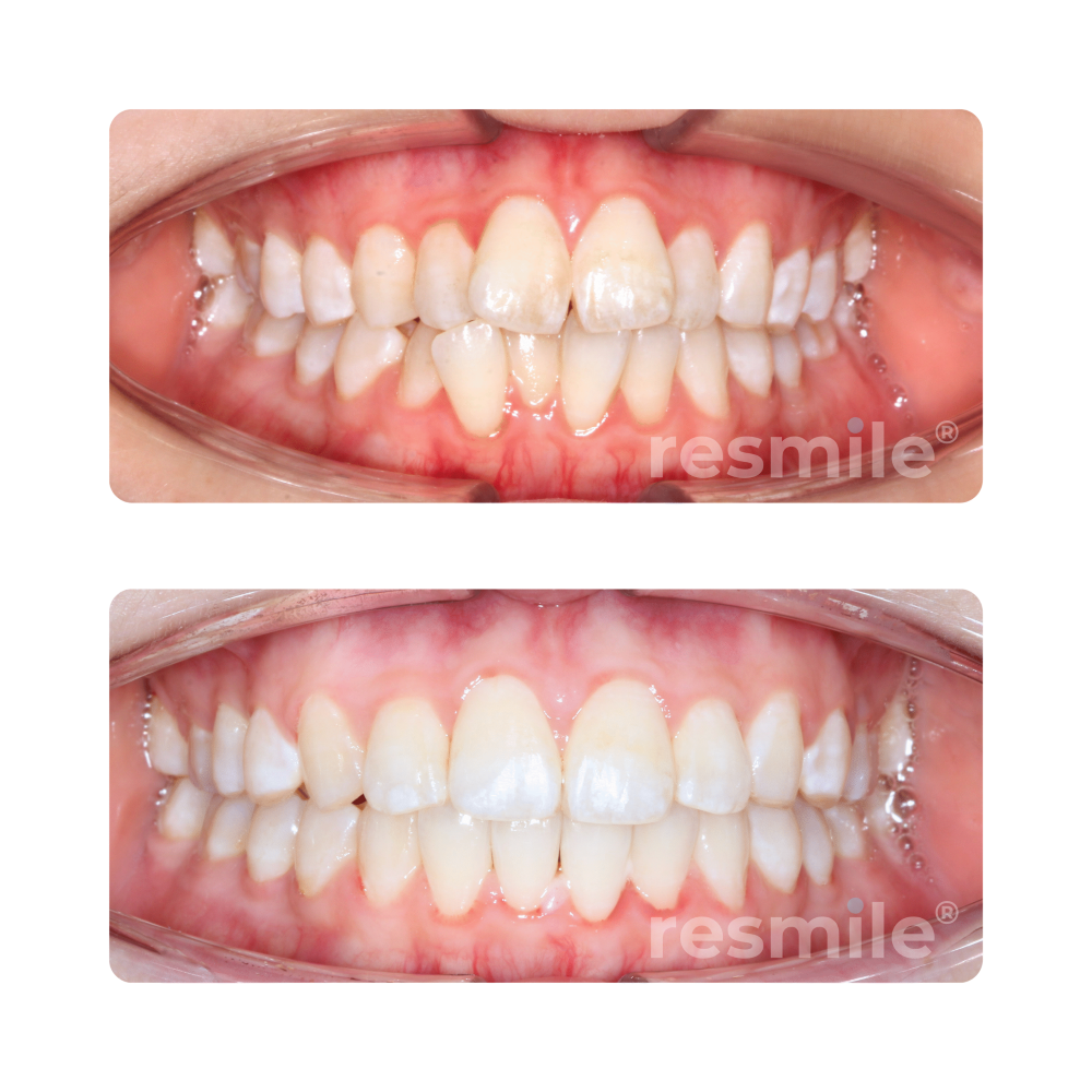 before-after-braces-2-scaled-resmile-dental