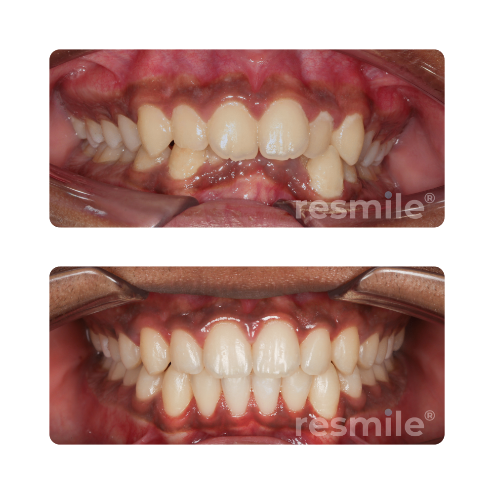 before-after-braces-3-scaled-resmile-dental