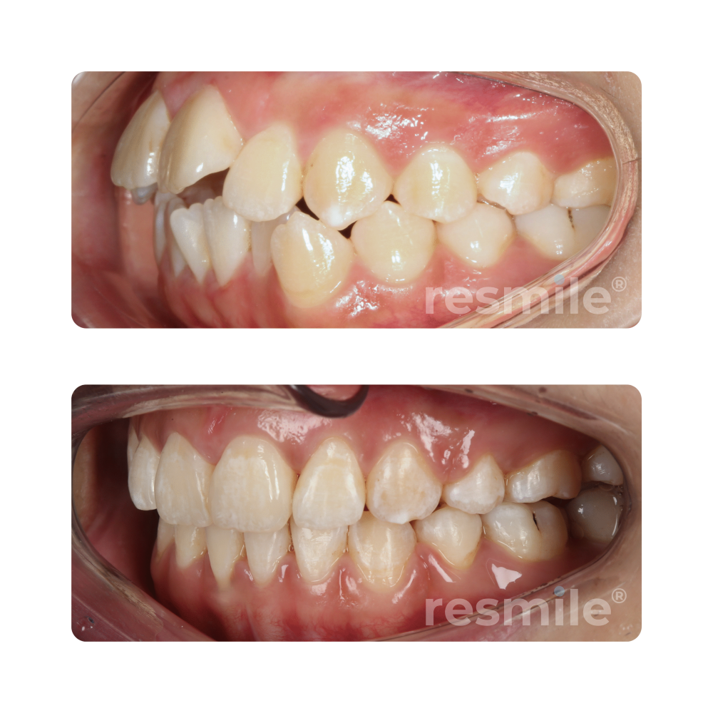before-after-braces-4-scaled-resmile-dental