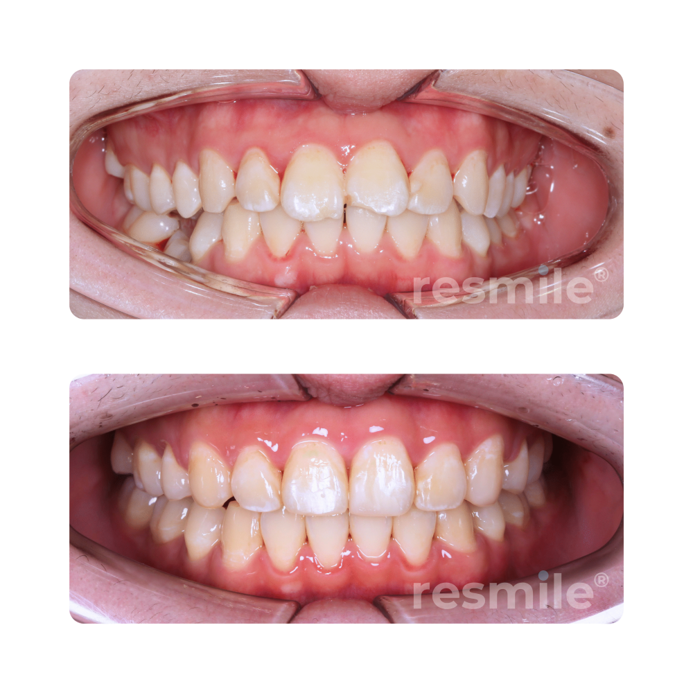 before-after-braces-5-scaled-resmile-dental