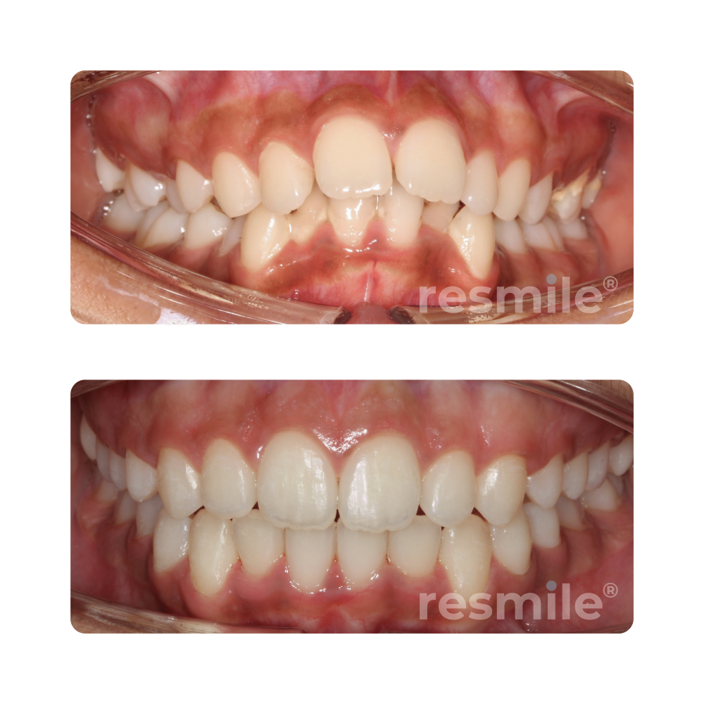 before-after-braces-6-scaled-resmile-dental