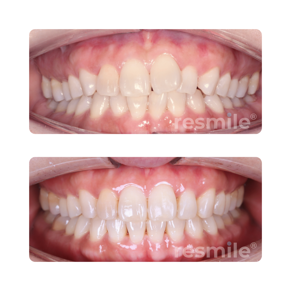 before-after-invisalign-10-scaled-resmile-dental