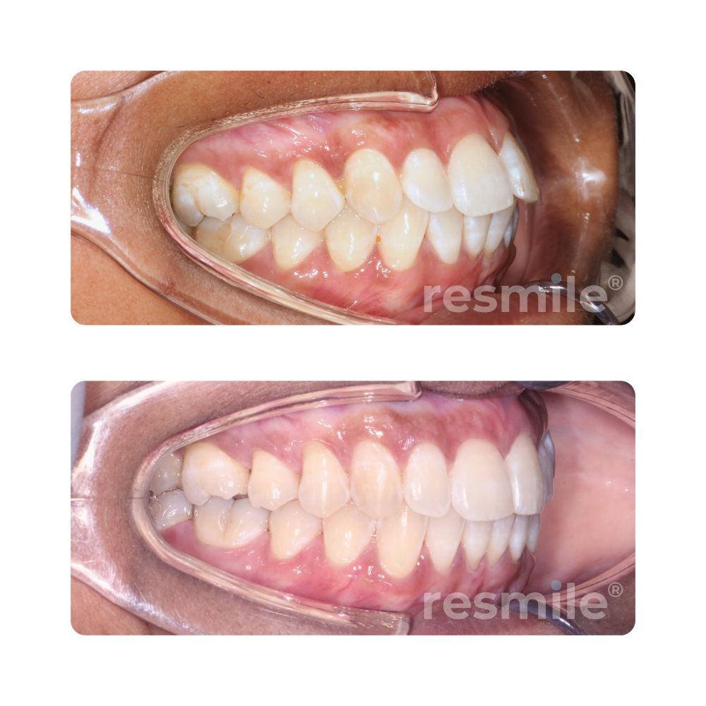 before-after-invisalign-11-scaled-resmile-dental