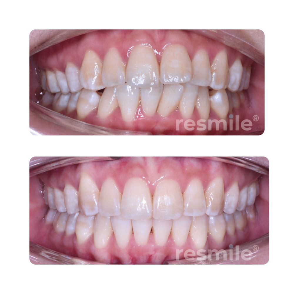 before-after-invisalign-12-scaled-resmile-dental