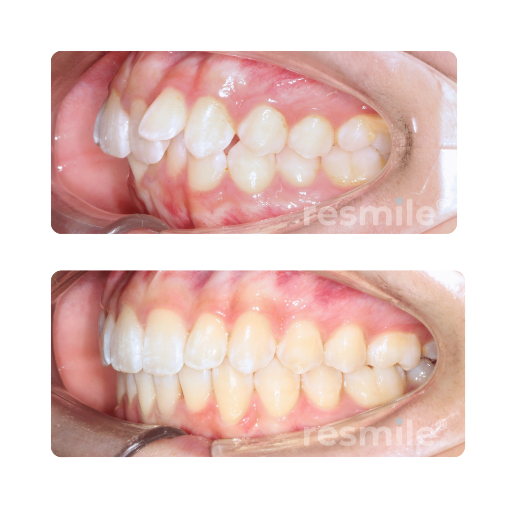 before-after-invisalign-13-scaled-resmile-dental