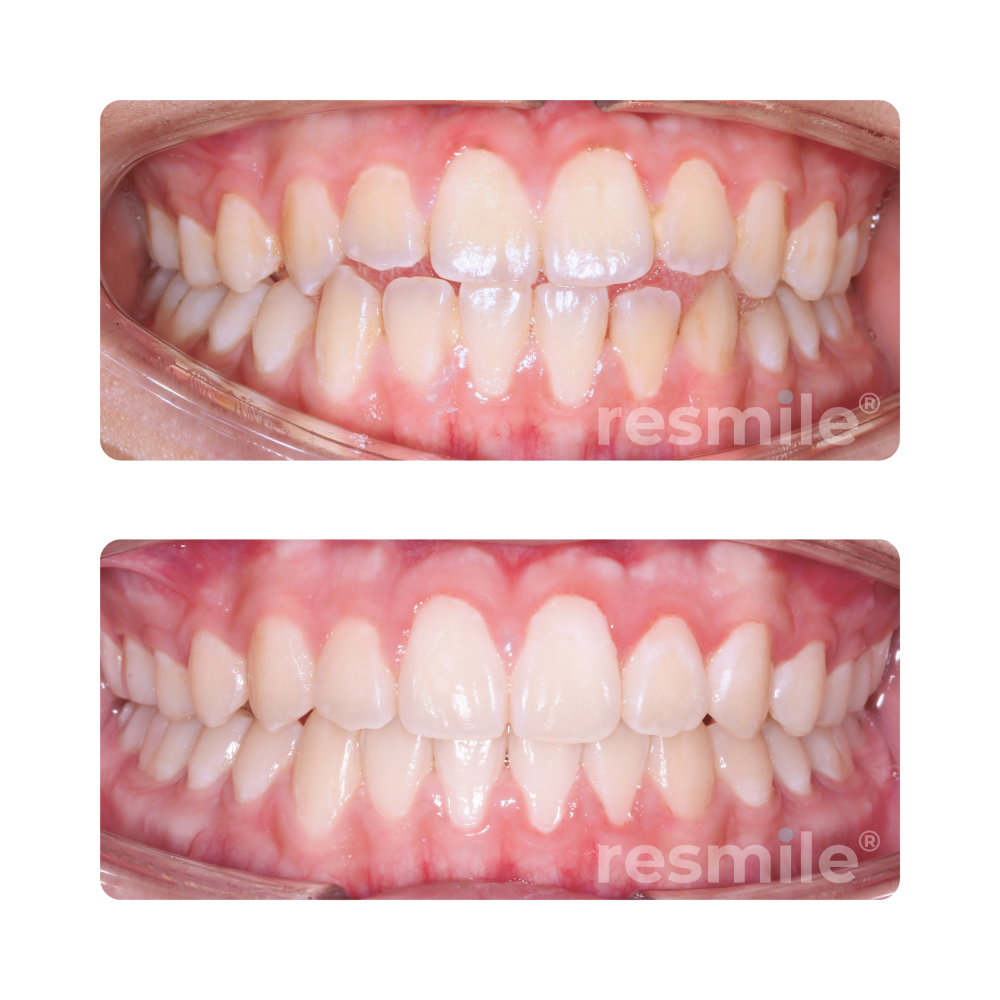 Invisalign Damansara uptown