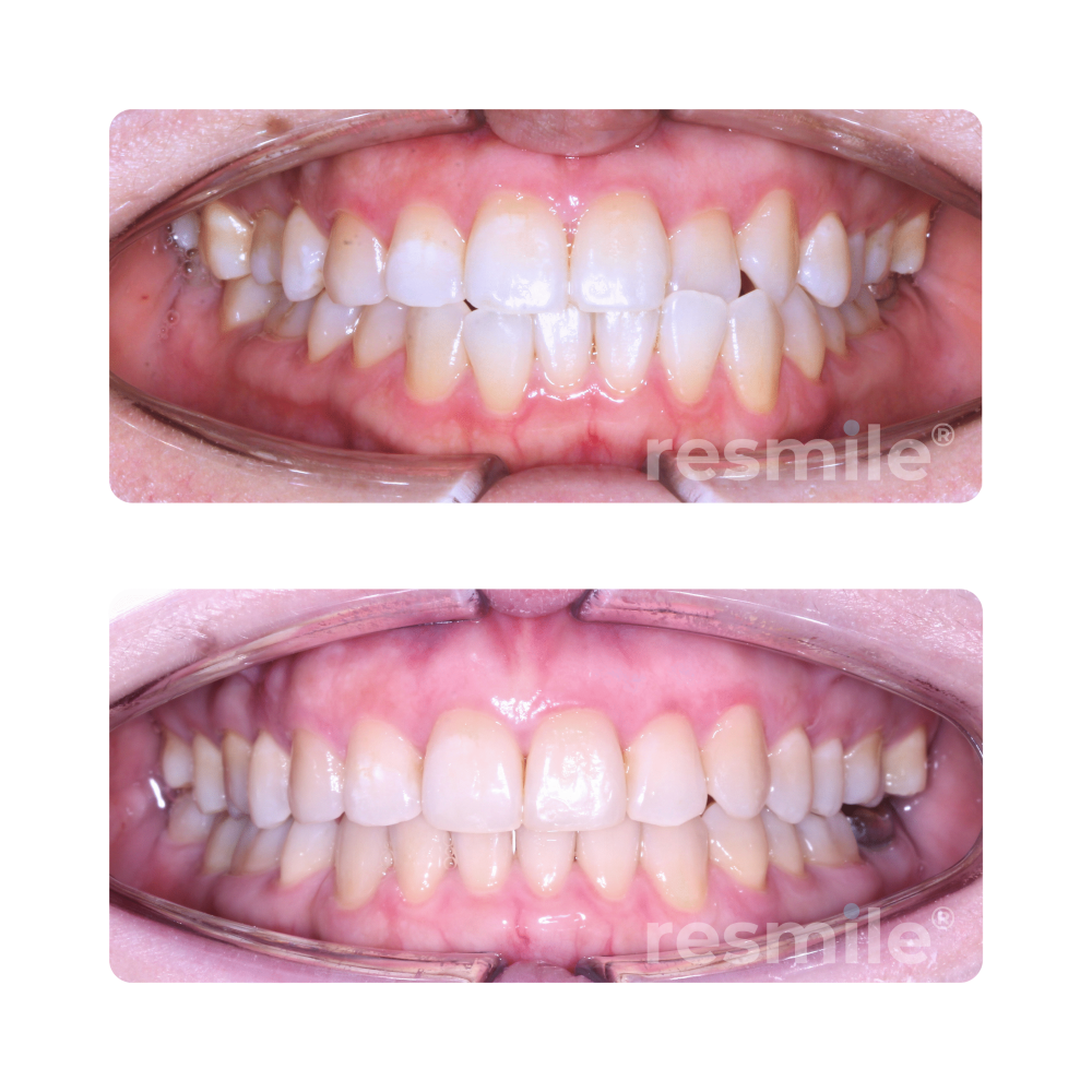 Invisalign Damansara uptown