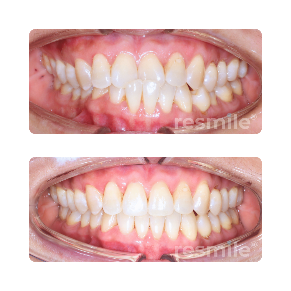 Invisalign service Damansara uptown