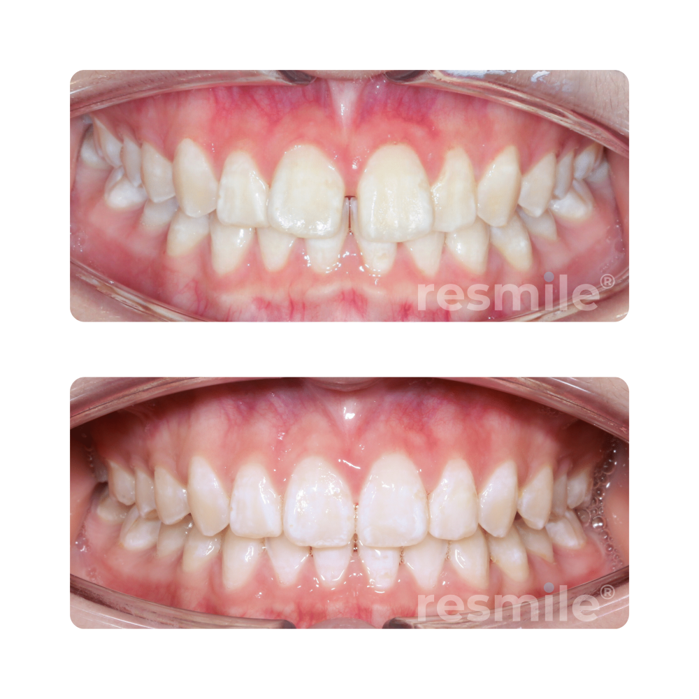 Invisalign service Damansara uptown