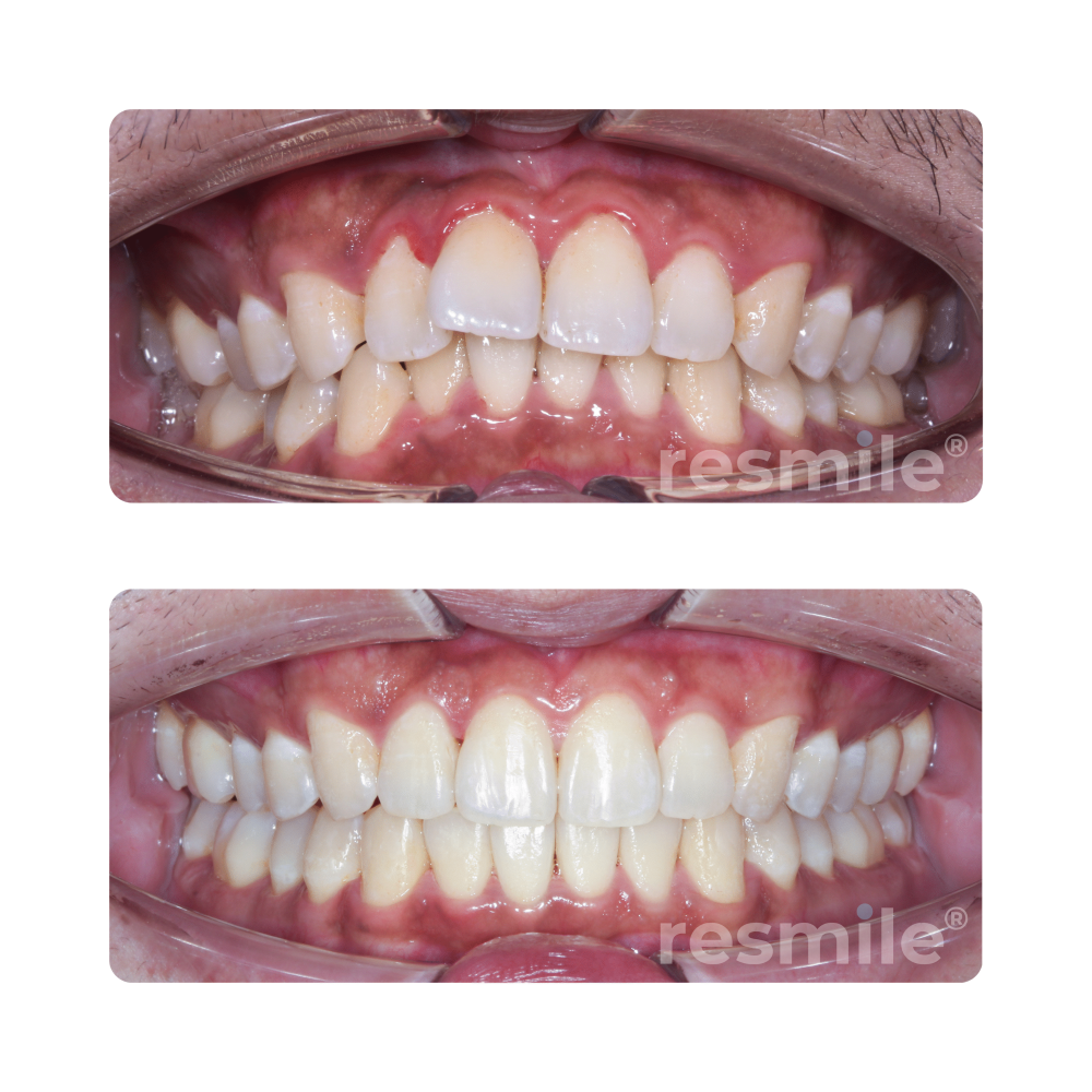 Invisalign service Damansara uptown