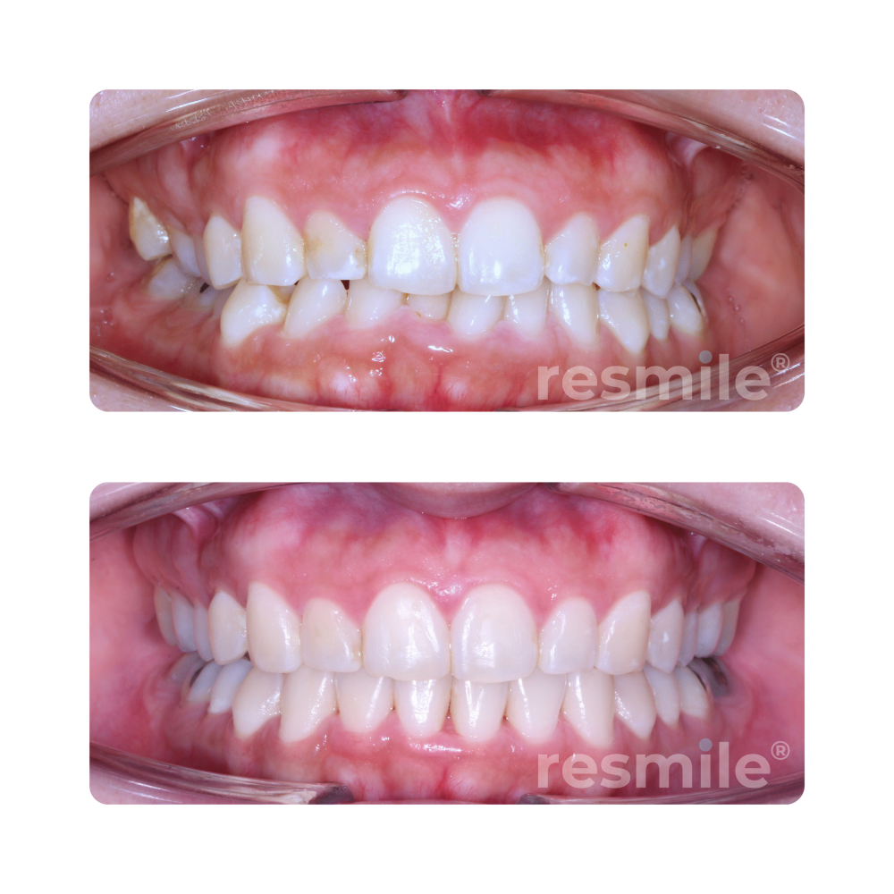 before-after-invisalign-8-scaled-resmile-dental