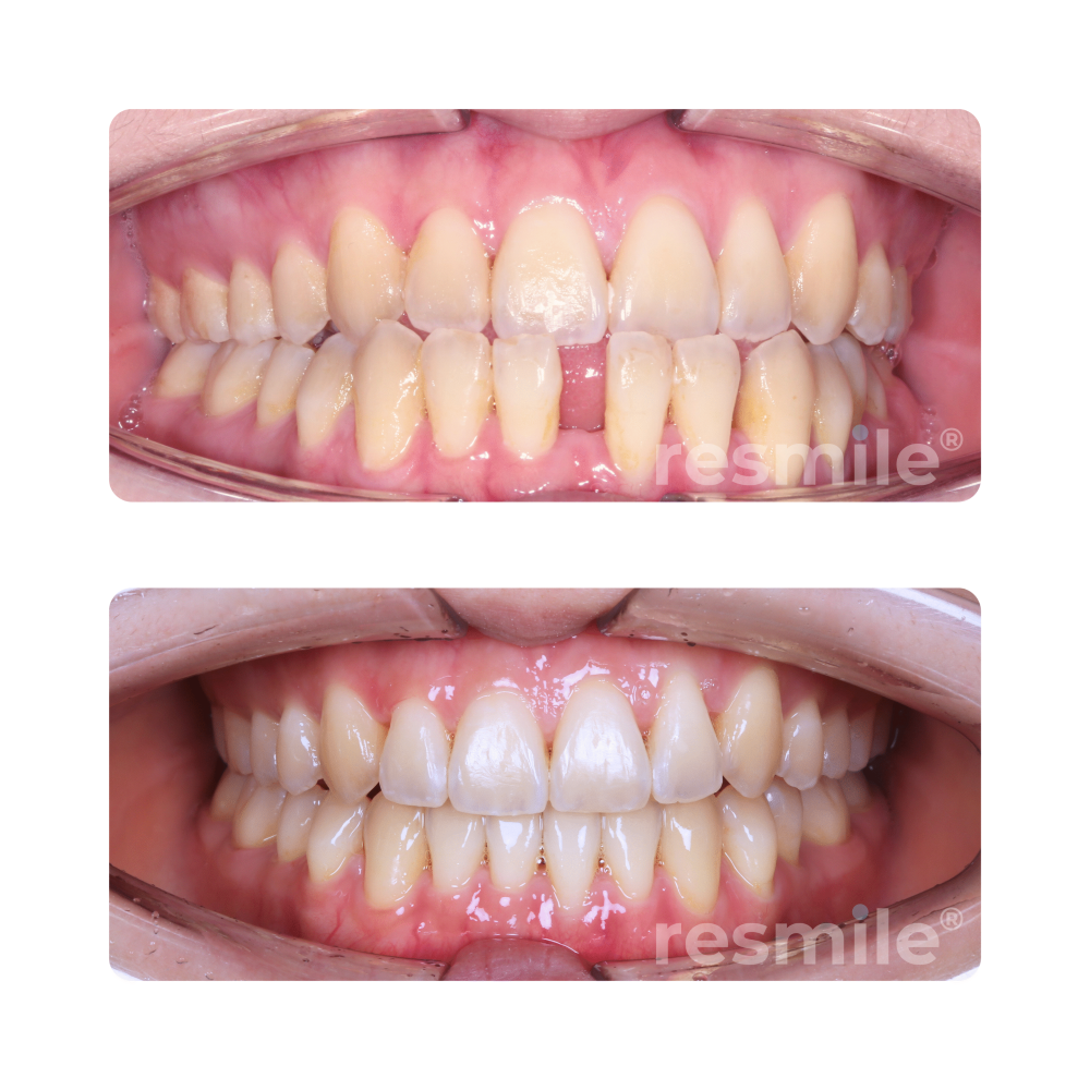before-after-invisalign-9-scaled-resmile-dental