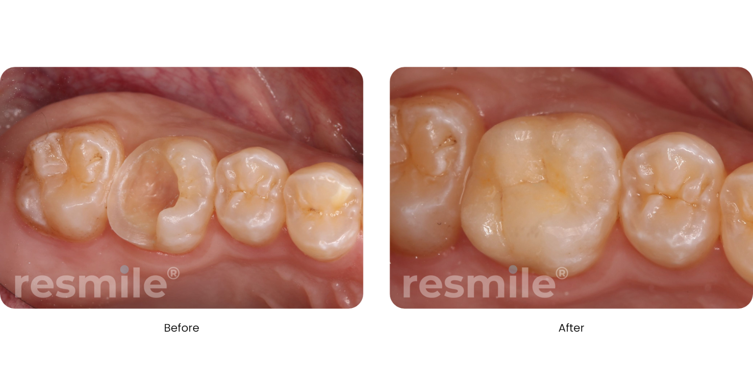 onlays-before-after-1-resmiledental