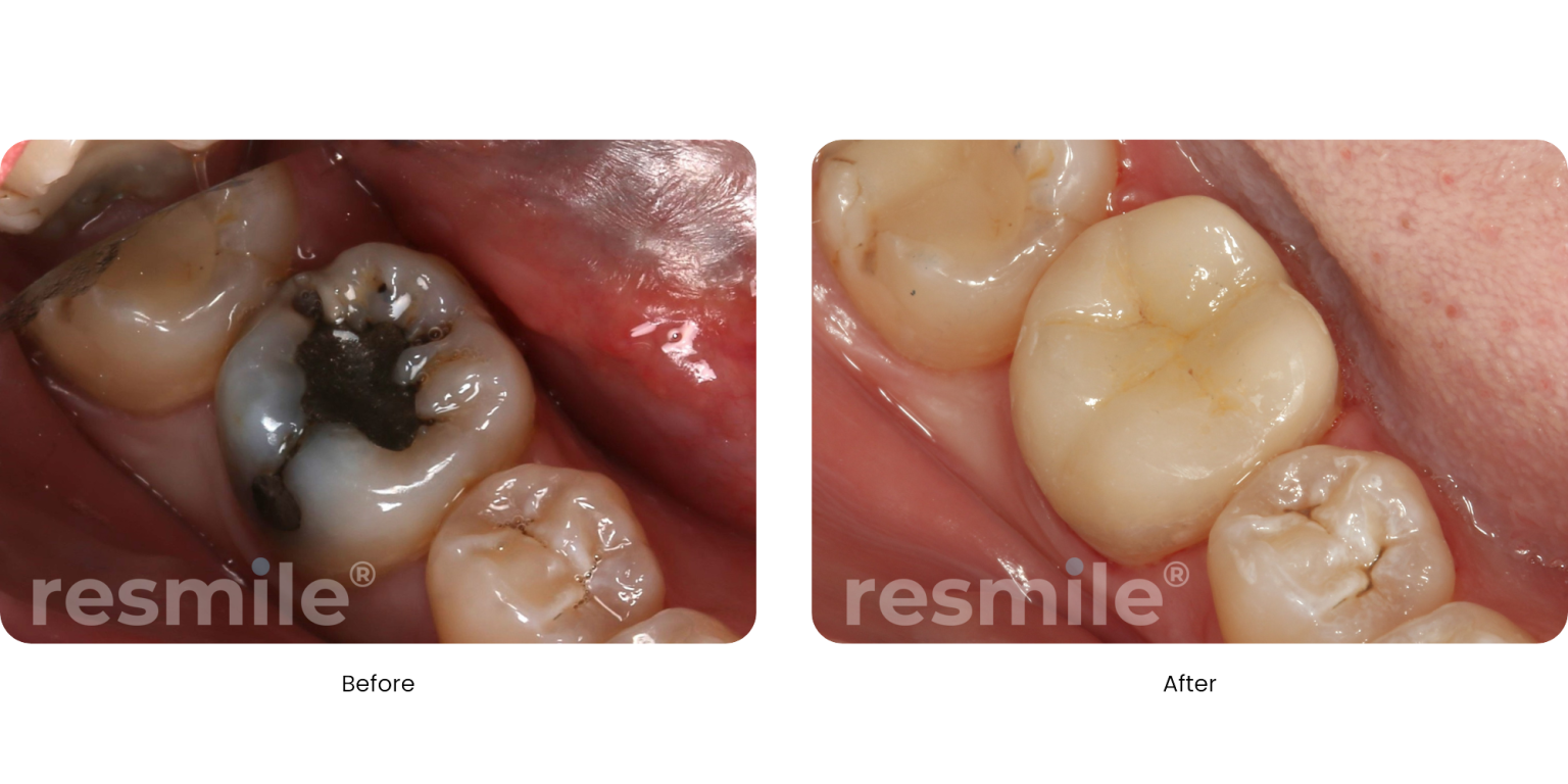 onlays-before-after-2-resmiledental