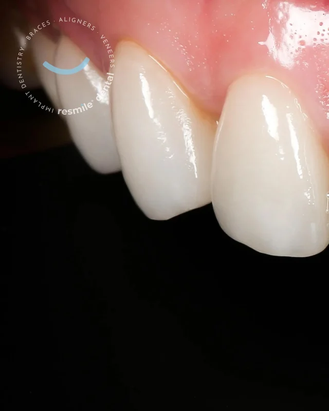 Porcelain veneers aren’t about changing who you are, they’re about letting your best smile shine through. ✨

Confidence, craftsmanship, and comfort, all in one healthy, natural-looking smile!

#resmile #resmiledental