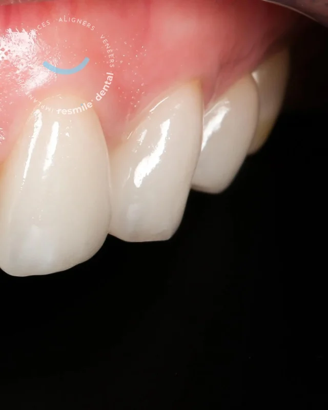 When porcelain is crafted right, the gums tell the story.

When veneers are thoughtfully designed and precisely fitted, your gums simply know it! They stay firm, pink, and beautifully textured (that gentle “orange peel” look that signals healthy gums). 

#resmile #resmiledental
