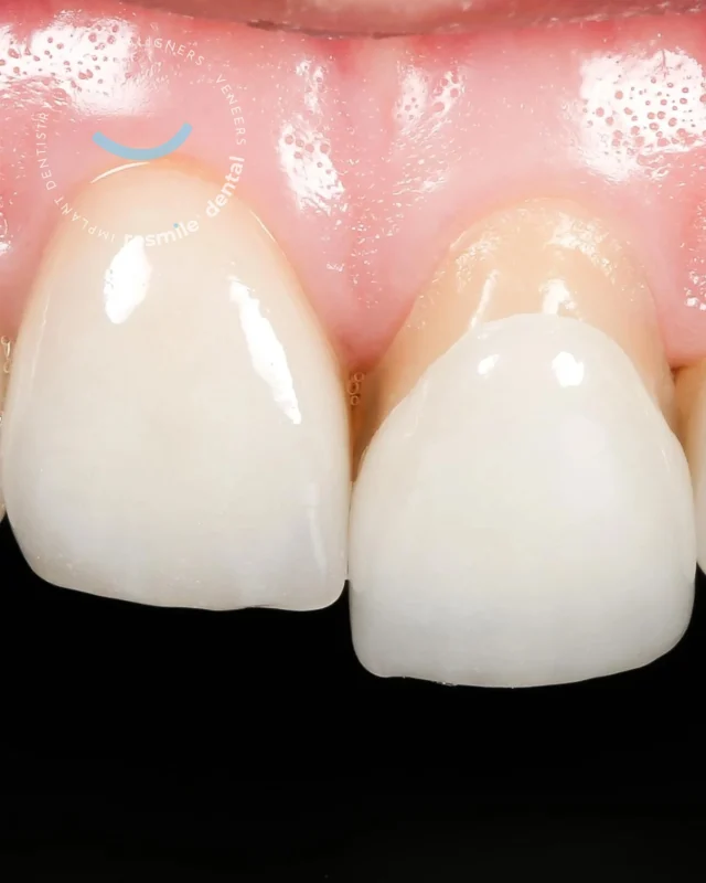 Natural-Looking Porcelain Veneers

They are still your teeth, just elevated in form and finesse! It’s the kind of beauty that whispers, not shouts. 

#resmile #resmiledental