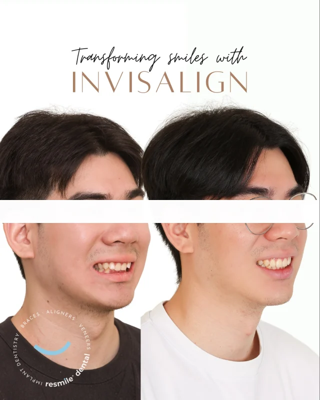 Here’s another beautiful Invisalign transformation at resmile dental, thoughtfully planned without extractions.
What made it even more rewarding was seeing such a wonderful result on a truly polite and gracious young man! Thank you for trusting us!

#resmile #resmiledental #invisalignkl #invisalignjourney