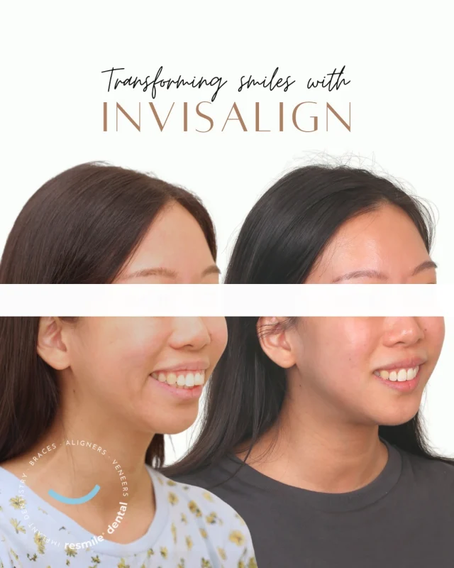 A smile that now sits more naturally, effortlessly.

With Invisalign, we corrected the protruding teeth and helped the lips settle into a more natural balance.
Sometimes all it takes is a little effort and perseverance to let the true smile shine! ⭐ 

Thank you for being such a joy to care for throughout this journey! 

#resmile #resmiledental #invisalignkl #invisalignjourney